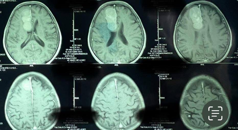 A Faculty Member at Al-Nahrain College of Medicine Successfully Performs a Complex Surgical Procedure to Remove a Large Meningioma